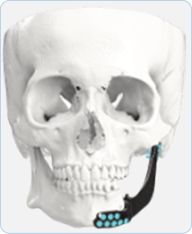 Craniofacial Reconstruction And Maxillofacial Surgery