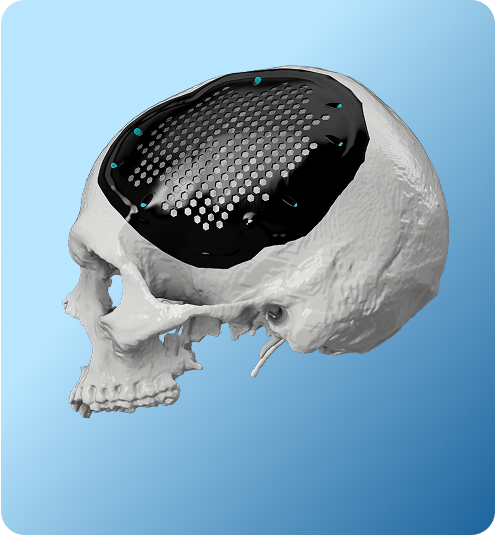 Overview of Cranial Vault Reconstruction