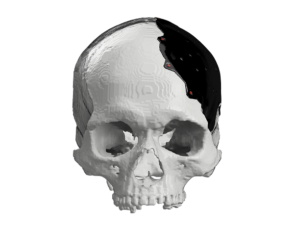 Polyetheretherketone (PEEK) Implants