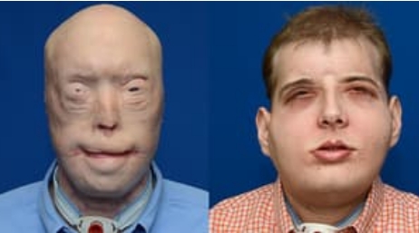 Virtual Surgical Planning Assists With Full Face Transplant
