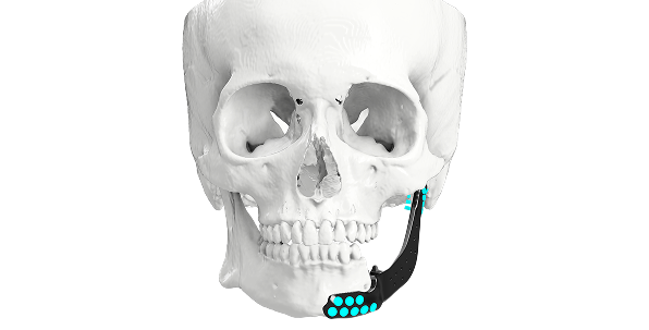 Reconstruction of Resected Mandible and Maxilla