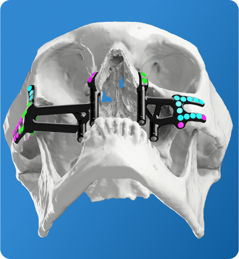 3D Printed Patient-Specific Implants