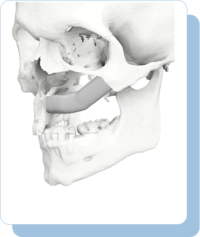 Overview of Mandible Reconstruction
