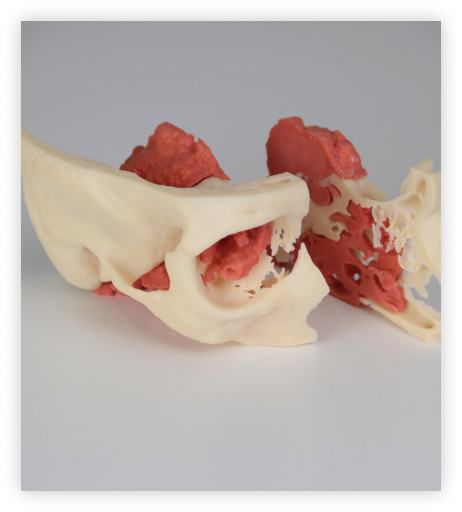 Regraft Bonerip - Patient Specific 3D printed models