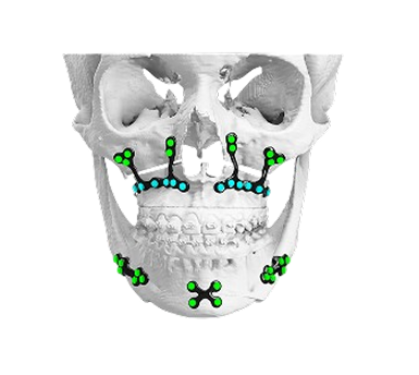 Regraft POS - Virtual Surgical Planning in Orthognathic Surgery