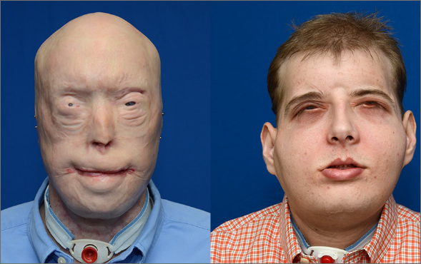 Virtual Surgical Planning Assists With Full Face Transplant