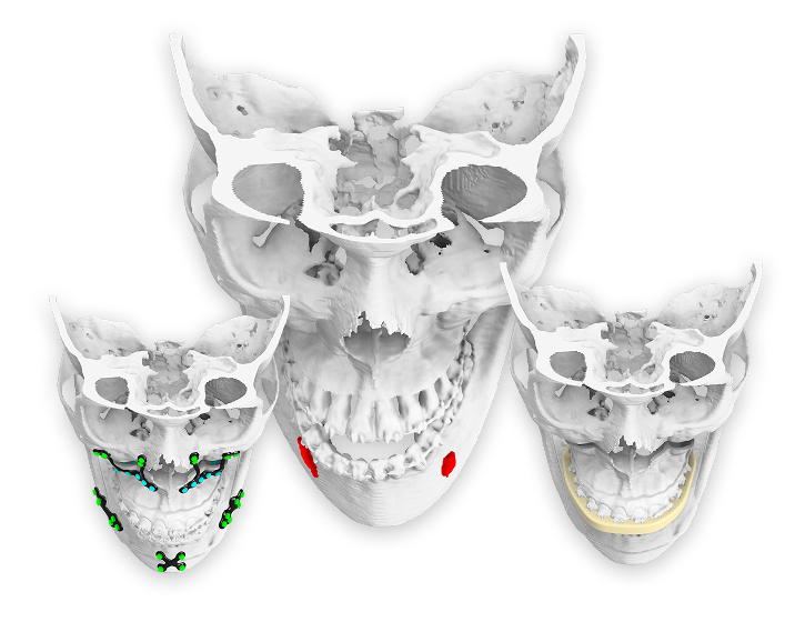 Virtual Surgical Planning Plates showcasing human skull 3D models