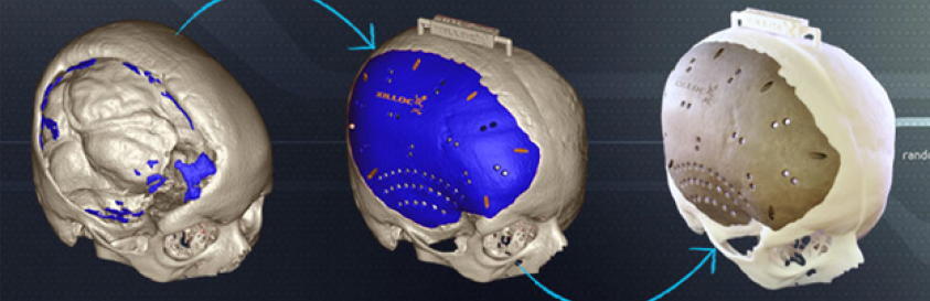 3D printed patient specific implants overview