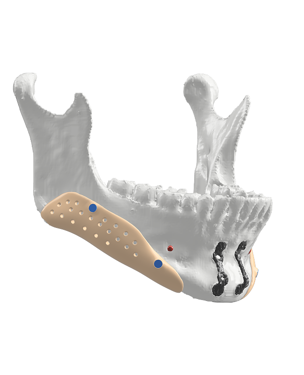 Advantages of 3D printed facial implants