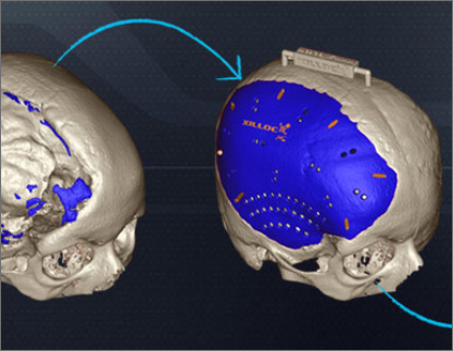 Patient Specific Implant