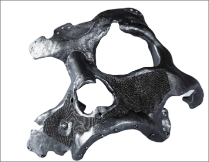 Patient Specific Implant