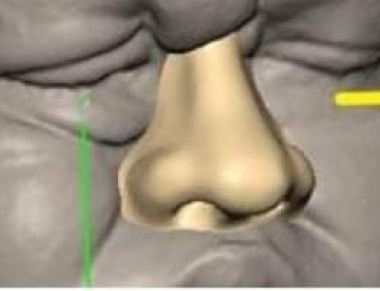 OralCase Study on replacing Cancer infected Nose with Artificial Nose Prosthesis