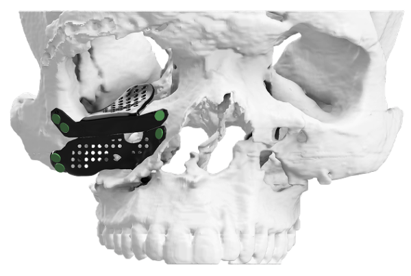 Regraft OBR - Orbital