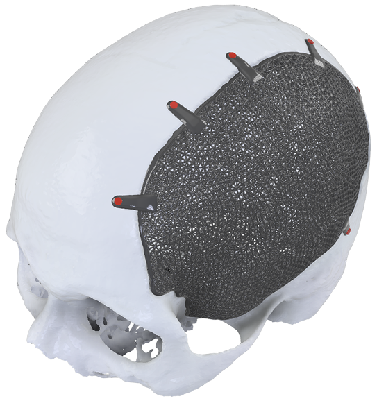 Regraft CVR - Cranial Vault