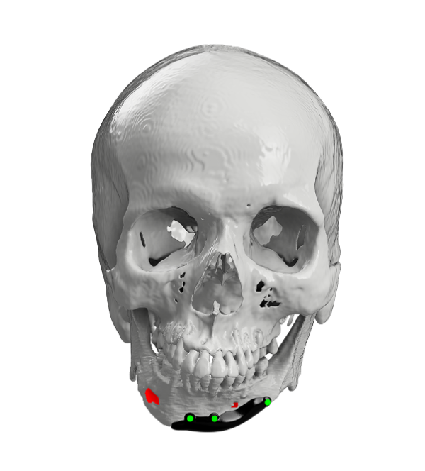 Regraft FD - Facial Deformities