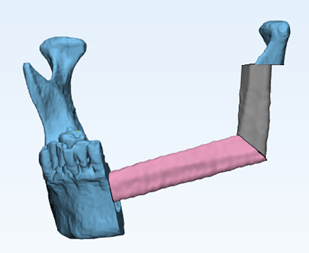Figure 2 fibula fragments adapted on removed defected region